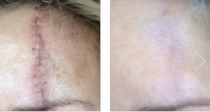 Venus Viva Scar Treatment