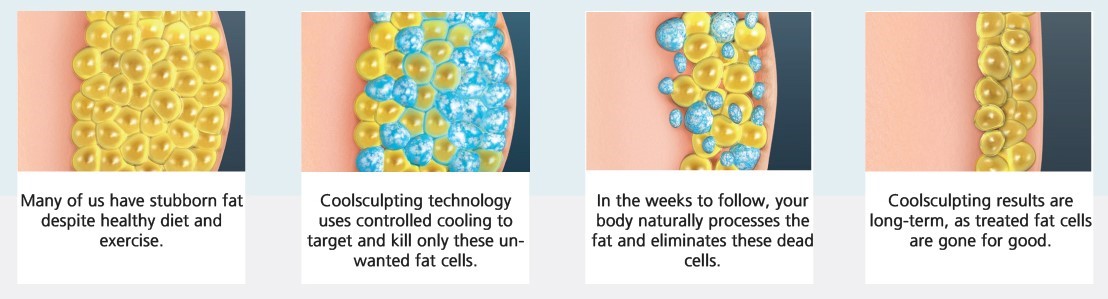 How does Coolsculpting works?