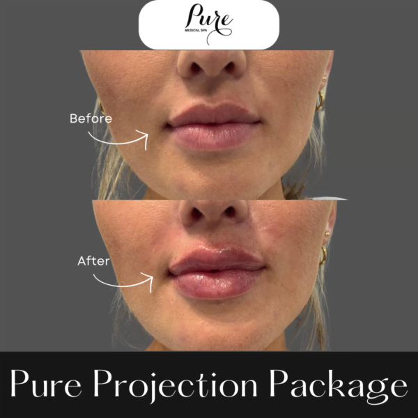 PURE Projection Package