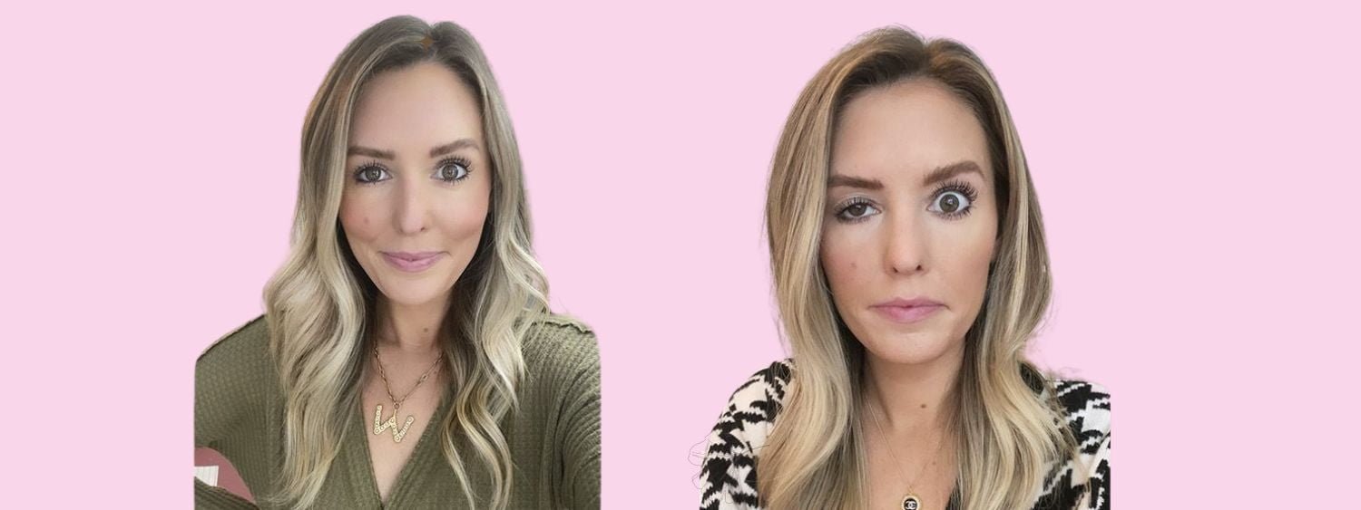 Droopy Eye Droopy Eye after Botox