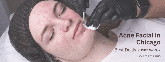 acne facial Acne Treatment