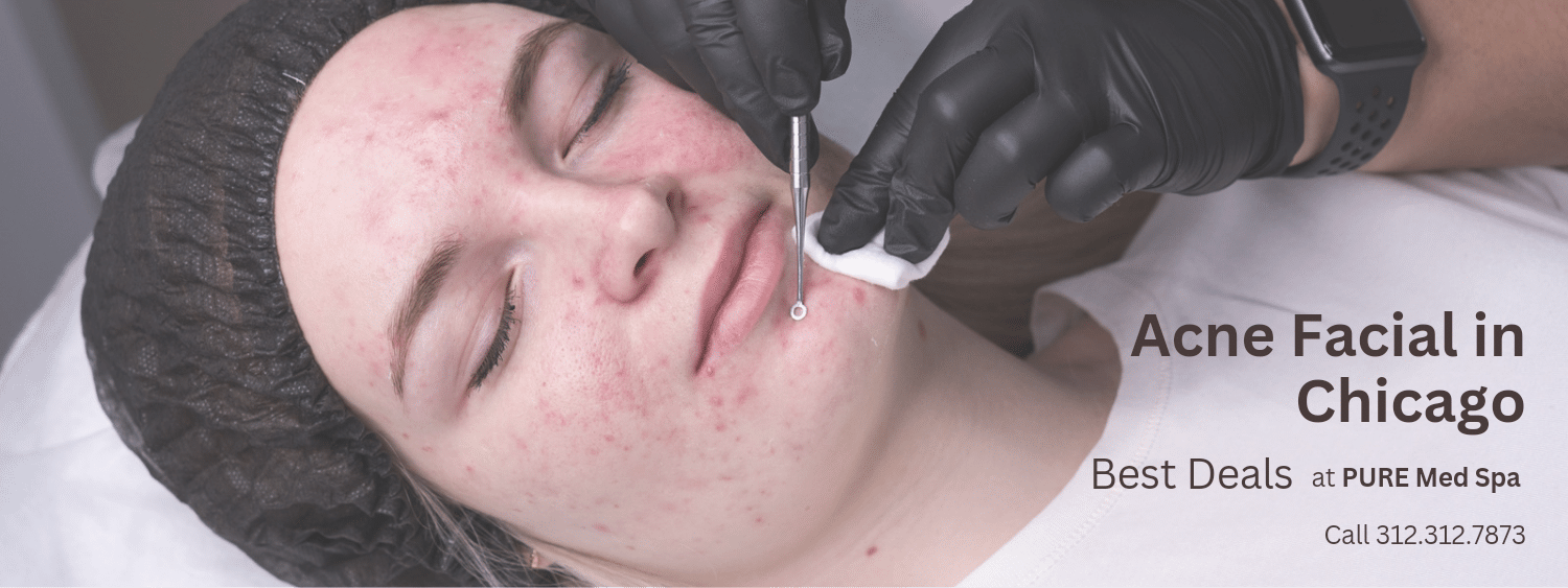 acne facial Acne Treatment