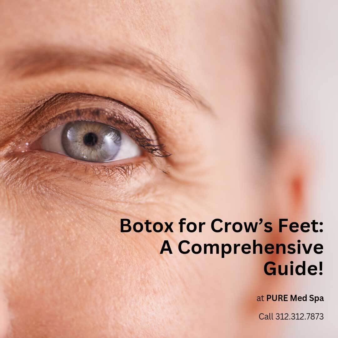 botox-for-crows-feet botox-for-crows-feet