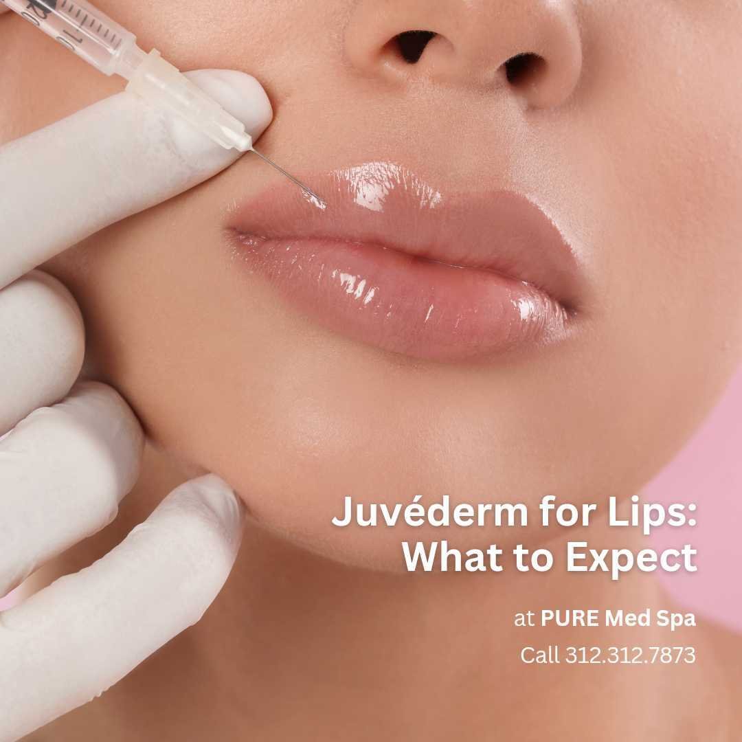 juvederm-for-lips juvederm-for-lips