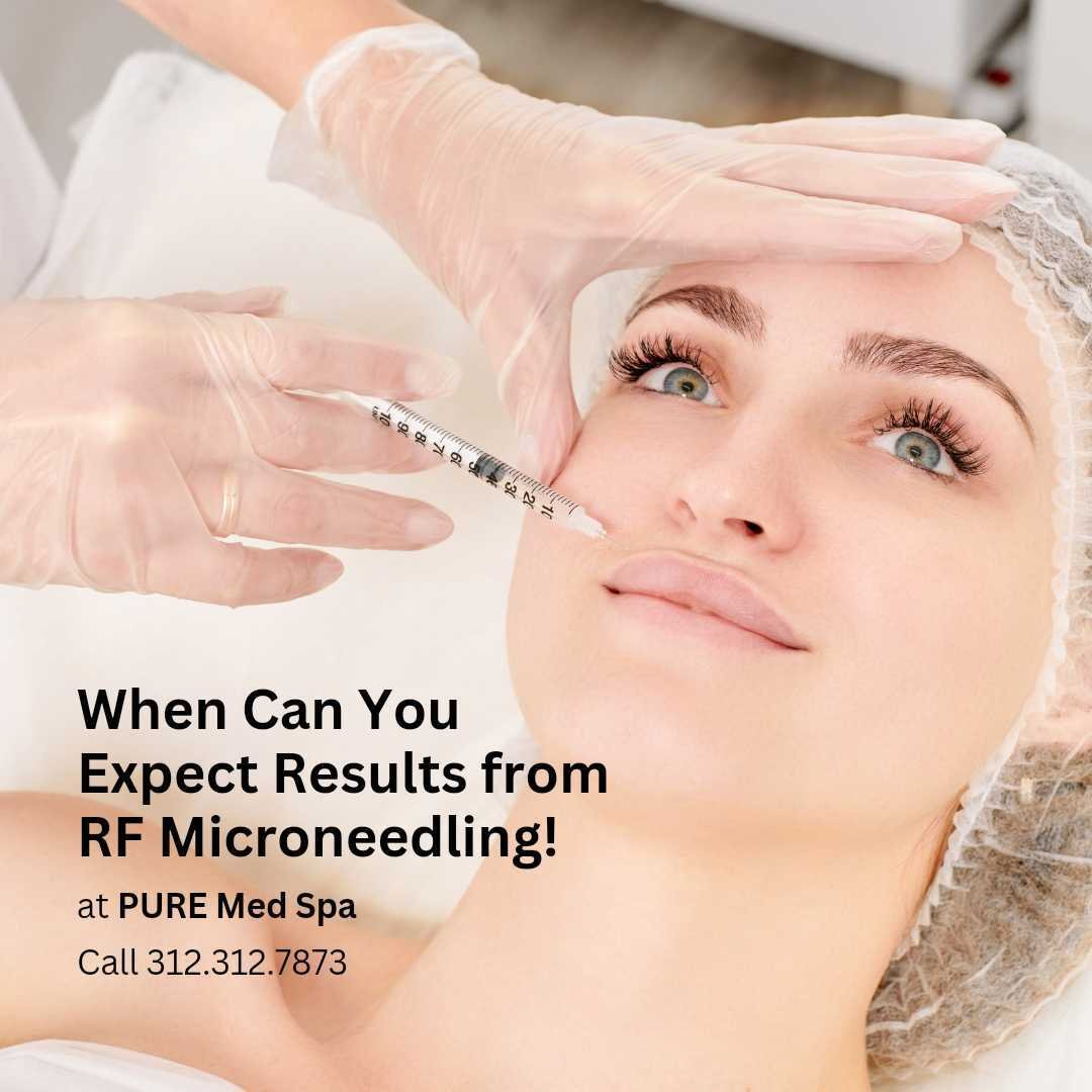 rf-microneedling rf-microneedling