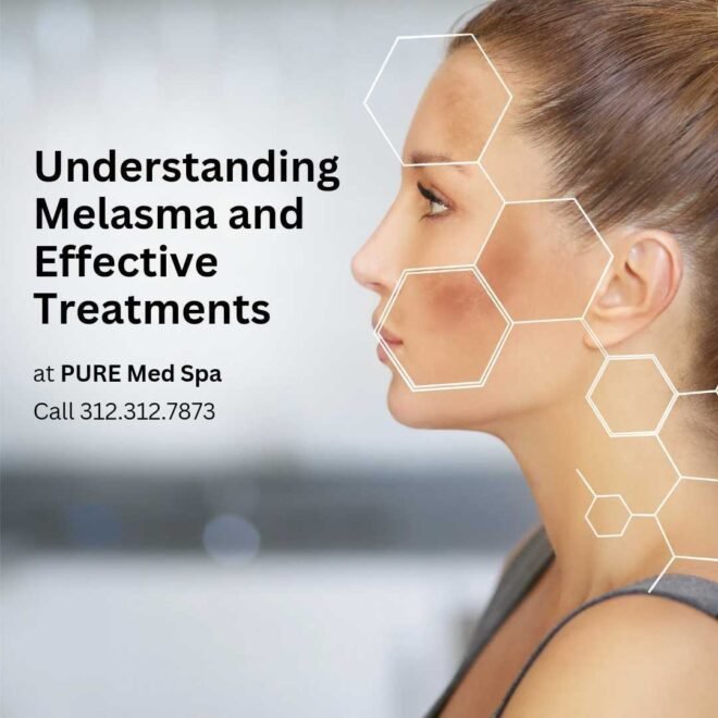 understanding-melasma