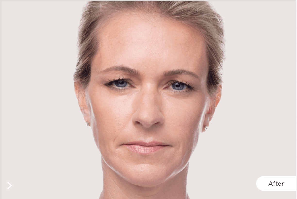 Dysport Before and After Image 1