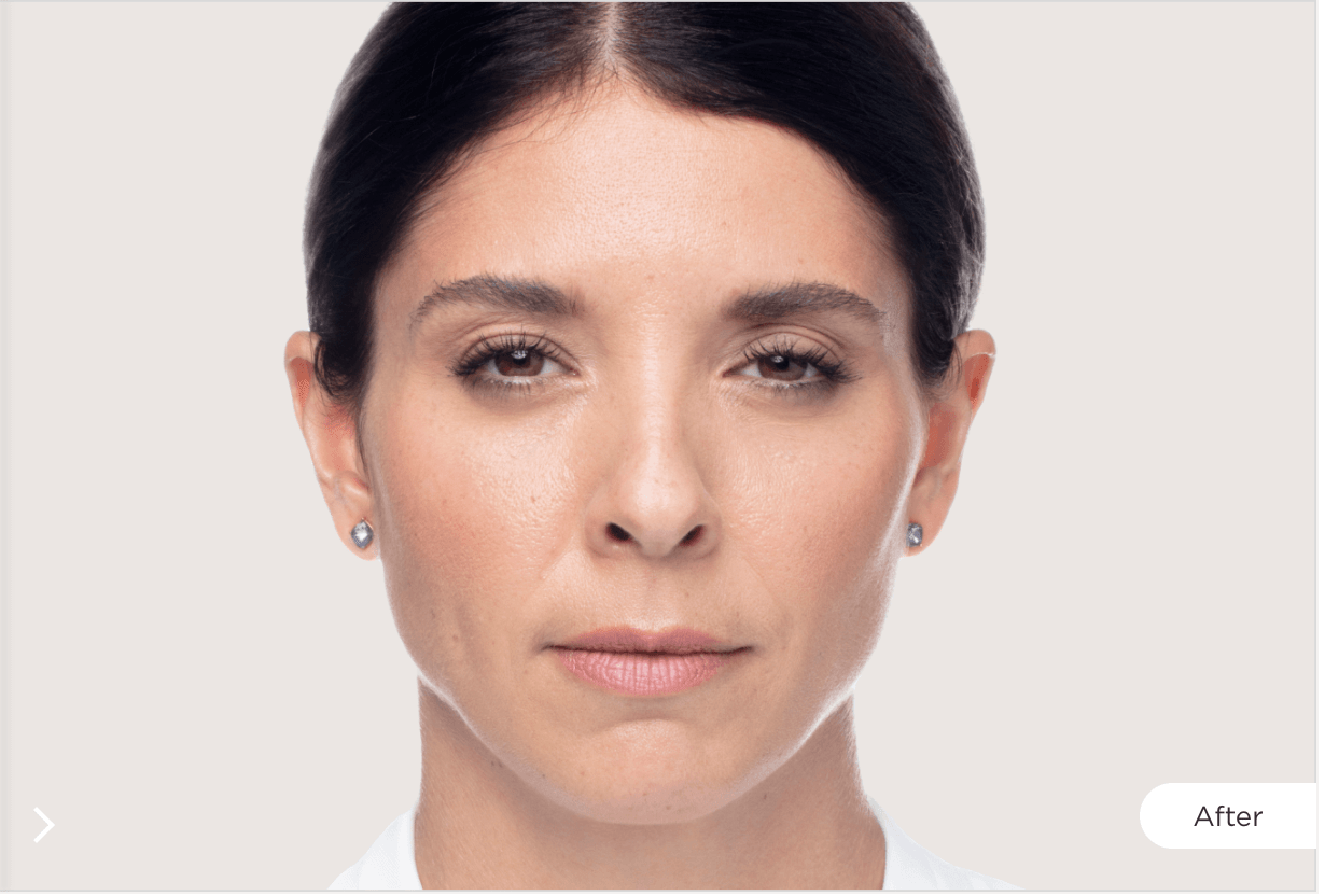 Dysport Before and After Image 2