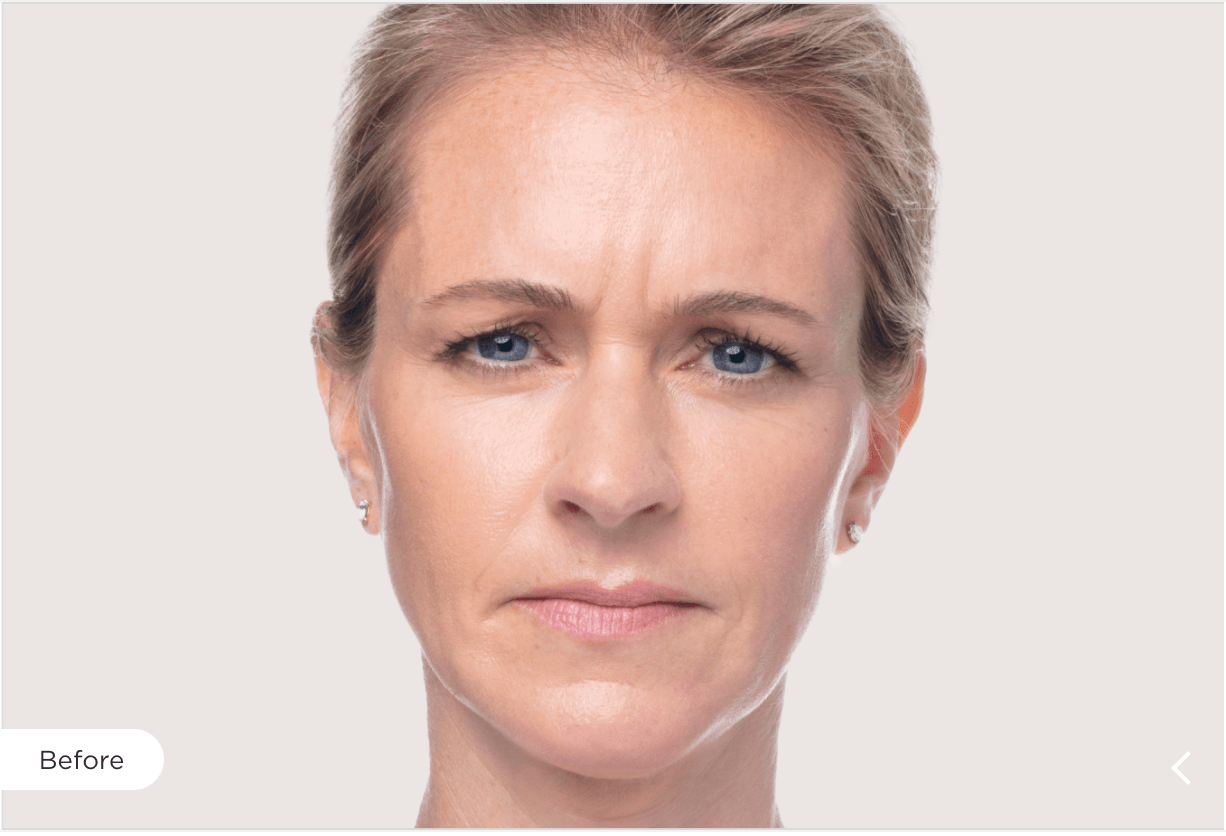 Dysport Before and After Image 1