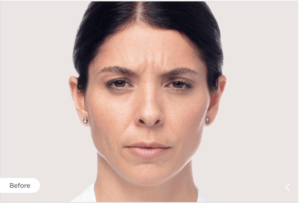 Dysport Before and After Image 2