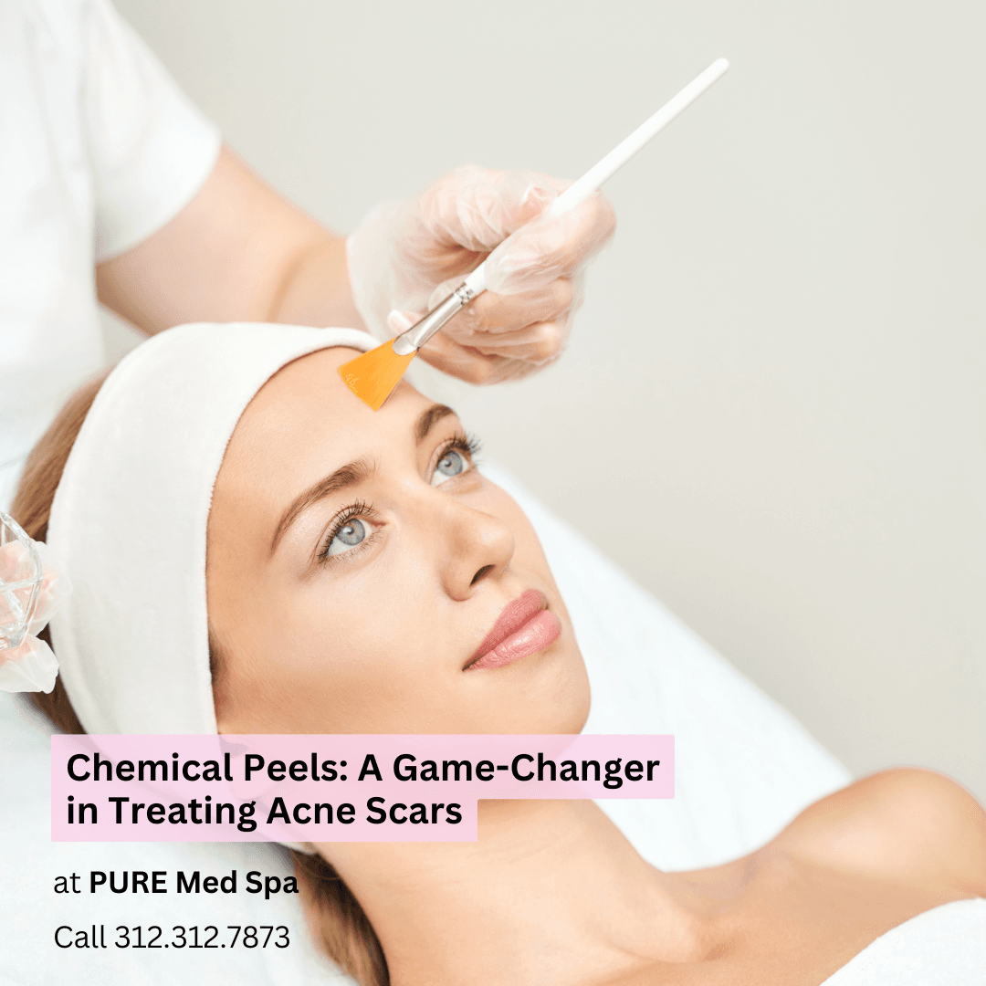 Chemical Peels Chemical Peels