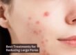 Best Treatments for Reducing Large Pores