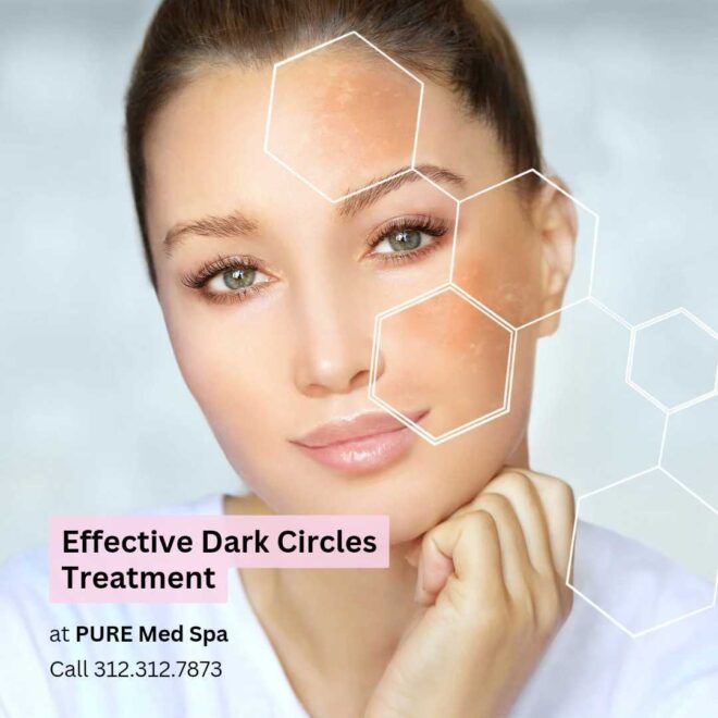 Effective Dark Circles Treatment Effective Dark Circles Treatment