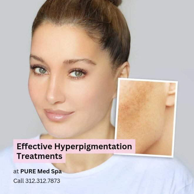 Effective Hyperpigmentation Treatments Effective Hyperpigmentation Treatments