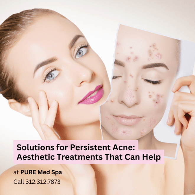 Solutions for Persistent Acne Aesthetic Treatments That Can Help Solutions for Persistent Acne Aesthetic Treatments That Can Help