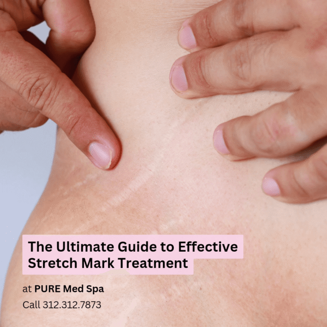 The Ultimate Guide to Effective Stretch Mark Treatment The Ultimate Guide to Effective Stretch Mark Treatment