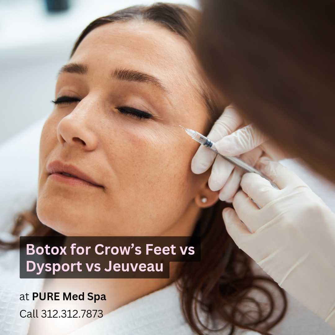 Botox for Crow’s Feet vs Dysport vs Jeuveau Botox for Crow’s Feet vs Dysport vs Jeuveau