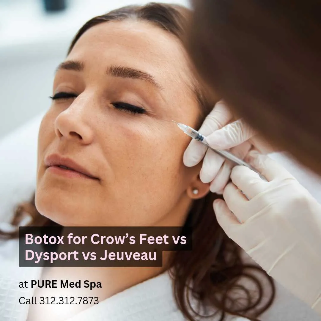 Botox for Crow’s Feet vs Dysport vs Jeuveau Botox for Crow’s Feet vs Dysport vs Jeuveau