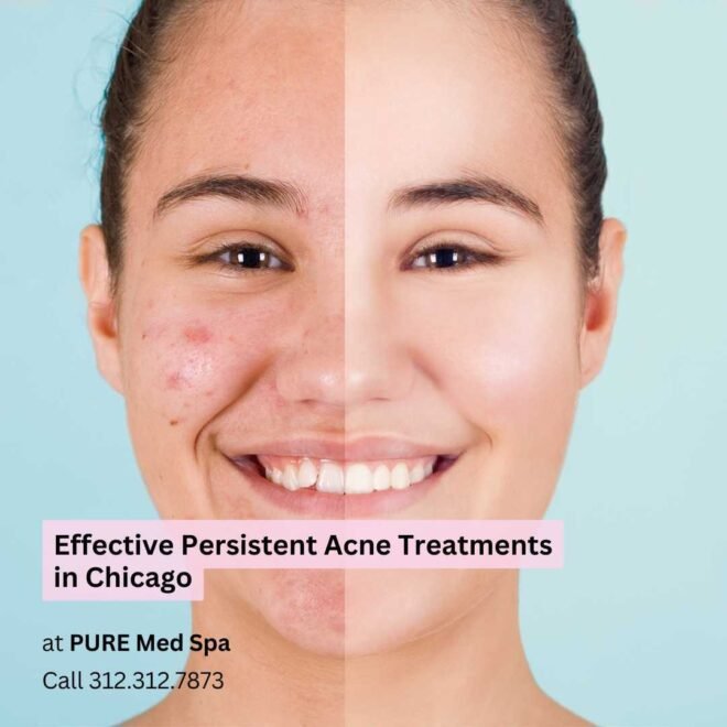 Effective Persistent Acne Treatments at Chicago
