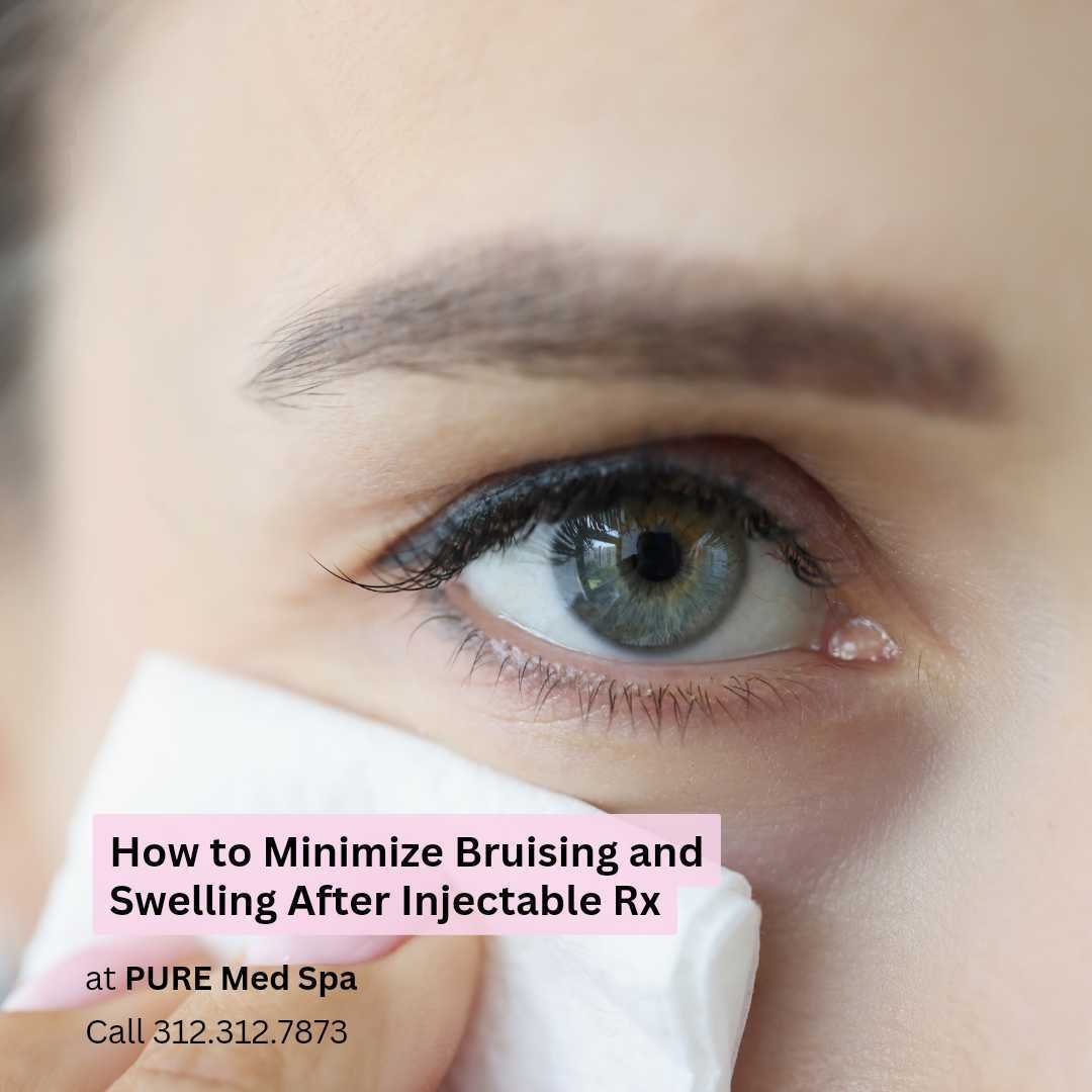How to Minimize Bruising and Swelling After Injectable Rx How to Minimize Bruising and Swelling After Injectable Rx