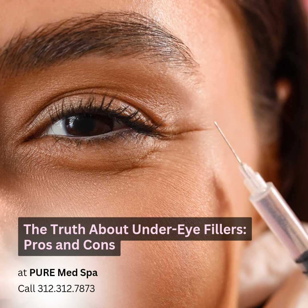 The truth about filler under eye The truth about filler under eye
