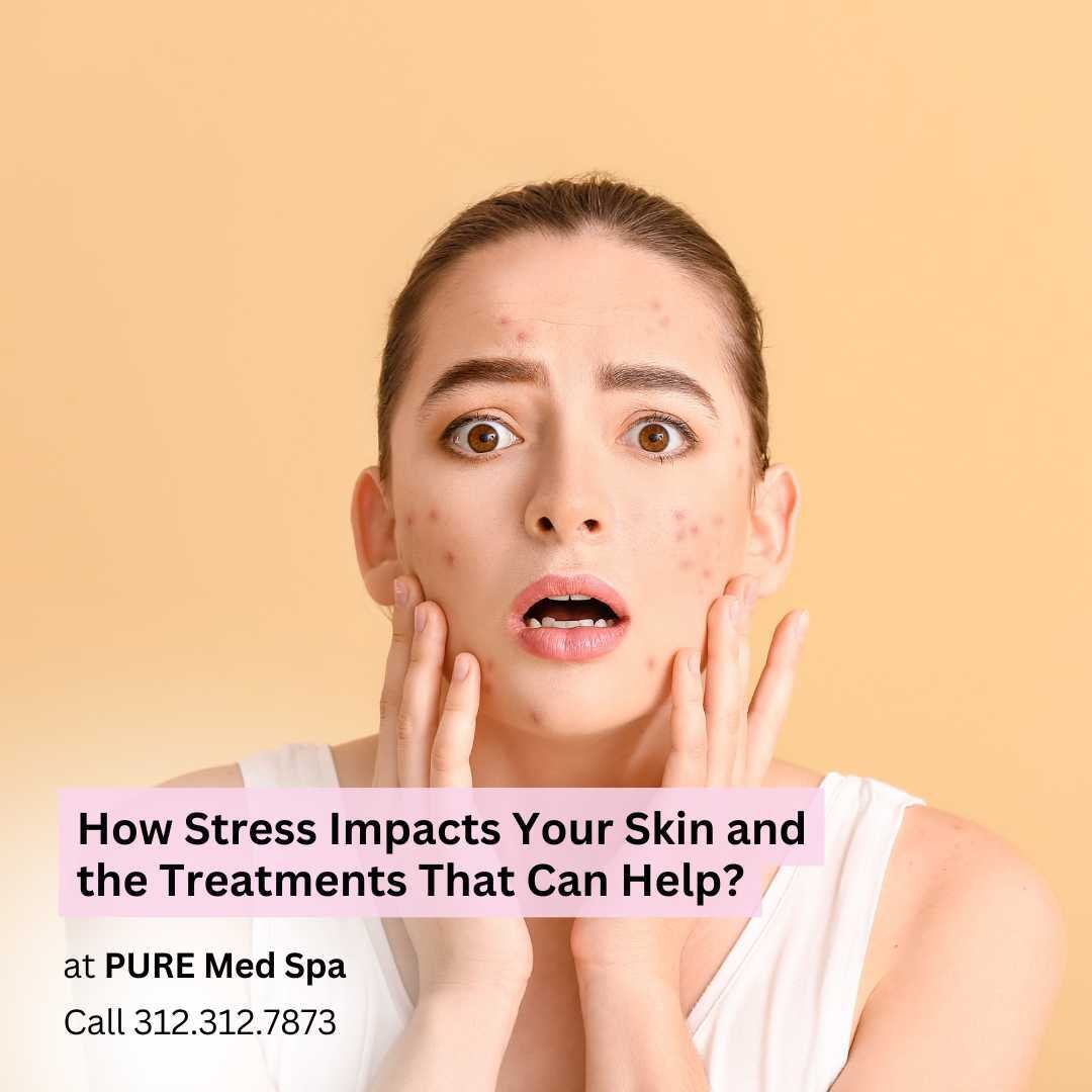 How Stress Impacts your skin How Stress Impacts Your Skin and the Treatments That Can Help