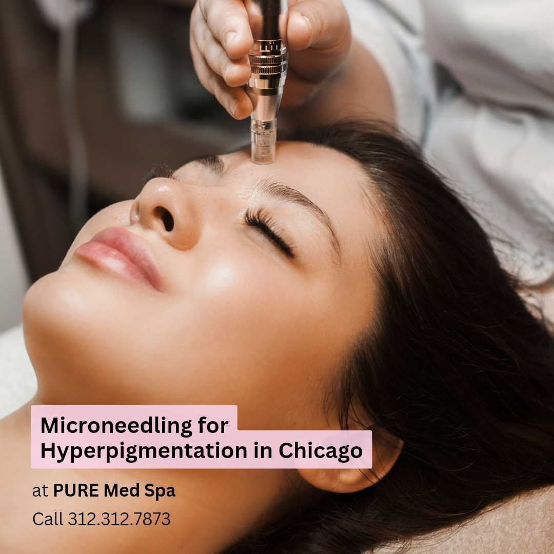 Microneedling for Hyperpigmentation at Pure Chicago Microneedling for Hyperpigmentation at Pure Chicago