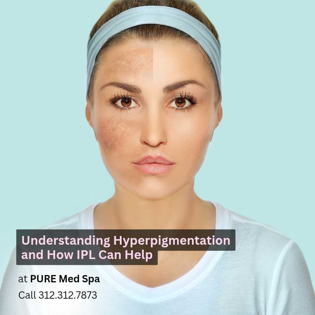 Understanding Hyperpigmentation and How IPL Can Help Understanding Hyperpigmentation and How IPL Can Help