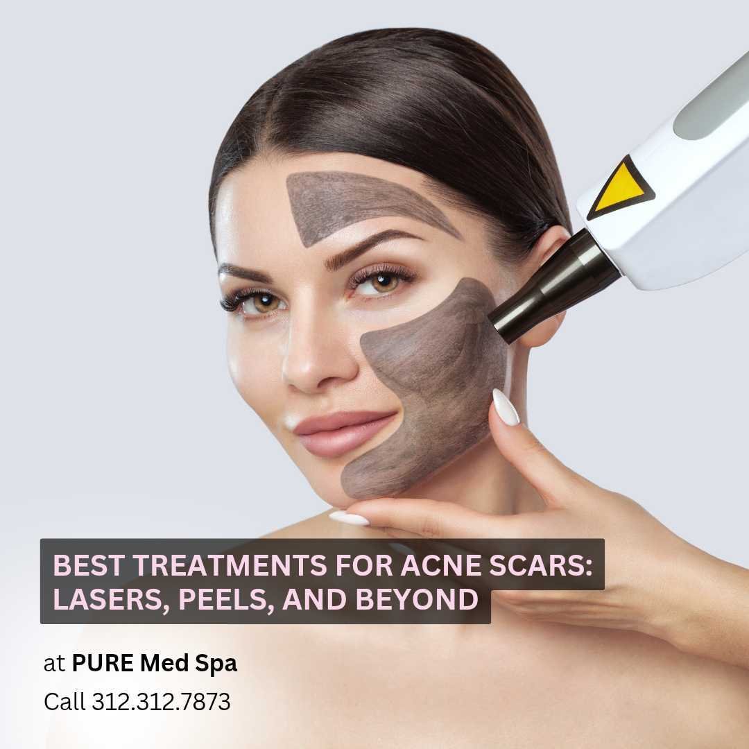 Best Treatments for Acne Scars Lasers, Peels, and Beyond Best Treatments for Acne Scars Lasers, Peels, and Beyond