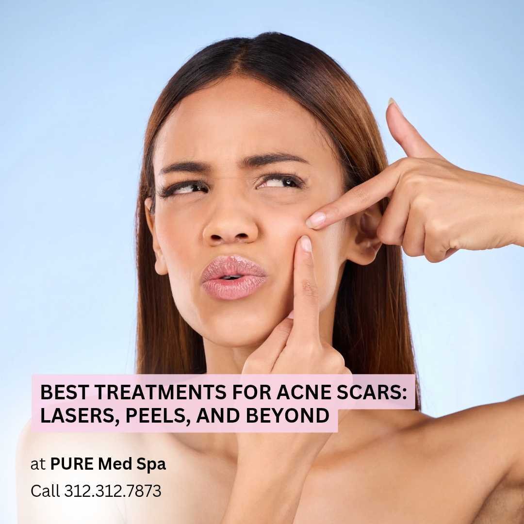 Best Treatments for Acne Scars Lasers, Peels, and Beyonds Best Treatments for Acne Scars Lasers, Peels, and Beyond