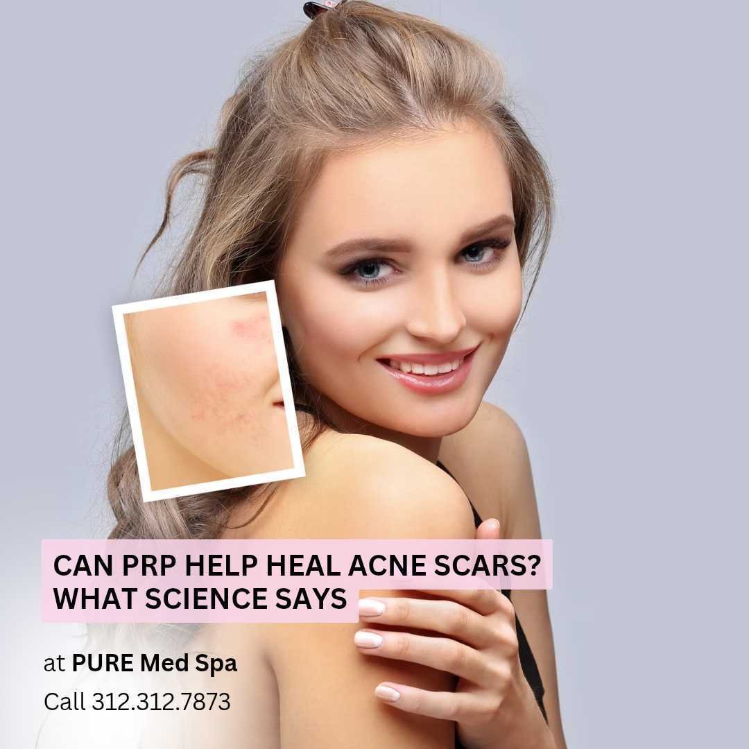 Can PRP Help Heal Acne Scars Can PRP Help Heal Acne Scars