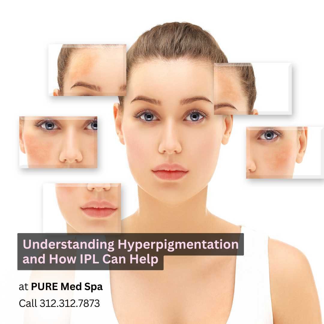 Understanding Hyperpigmentation Understanding Hyperpigmentation