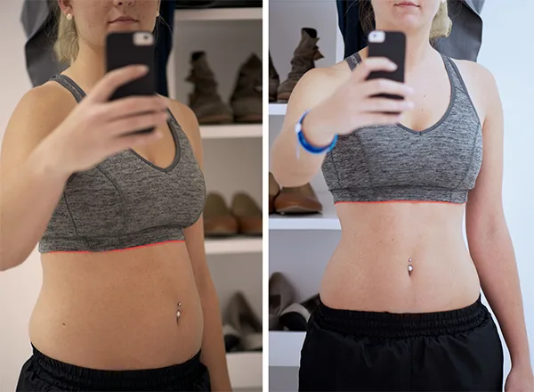 Before treatment for weight loss in a 25-year-old female patient at Pure Medical Spa