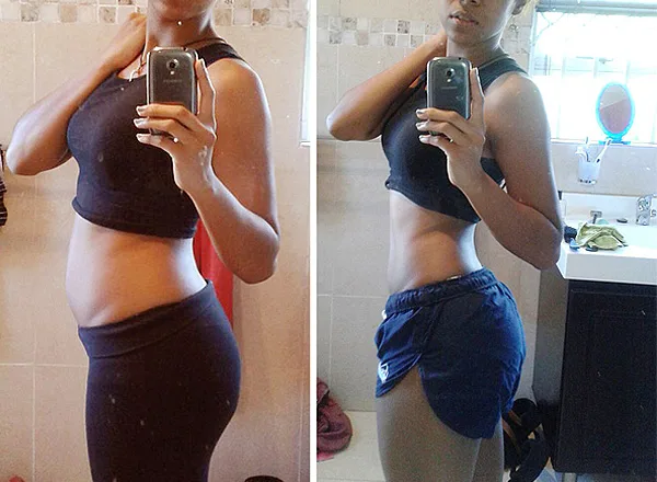 Before treatment for weight loss in a 21-year-old female patient at Pure Medical Spa