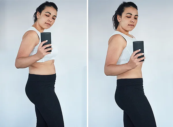 Before Tirezepatide treatment for weight loss in a 30-year-old female patient at Pure Medical Spa