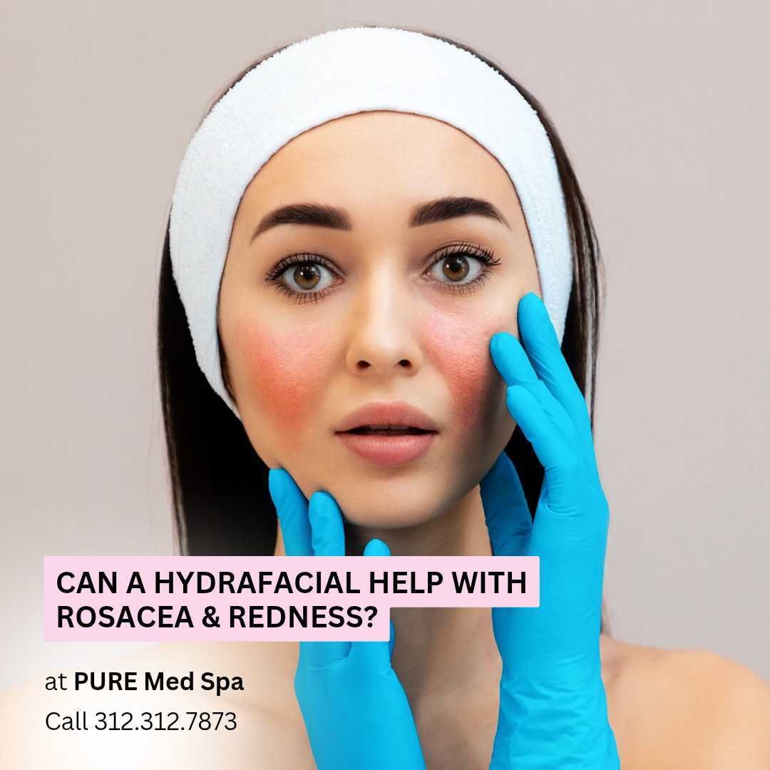 Can a HydraFacial Help with Rosacea & Redness (1) Can a HydraFacial Help with Rosacea & Redness
