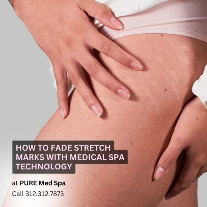 How to Fade Stretch Marks with Medical Spa Technology How to Fade Stretch Marks with Medical Spa Technology