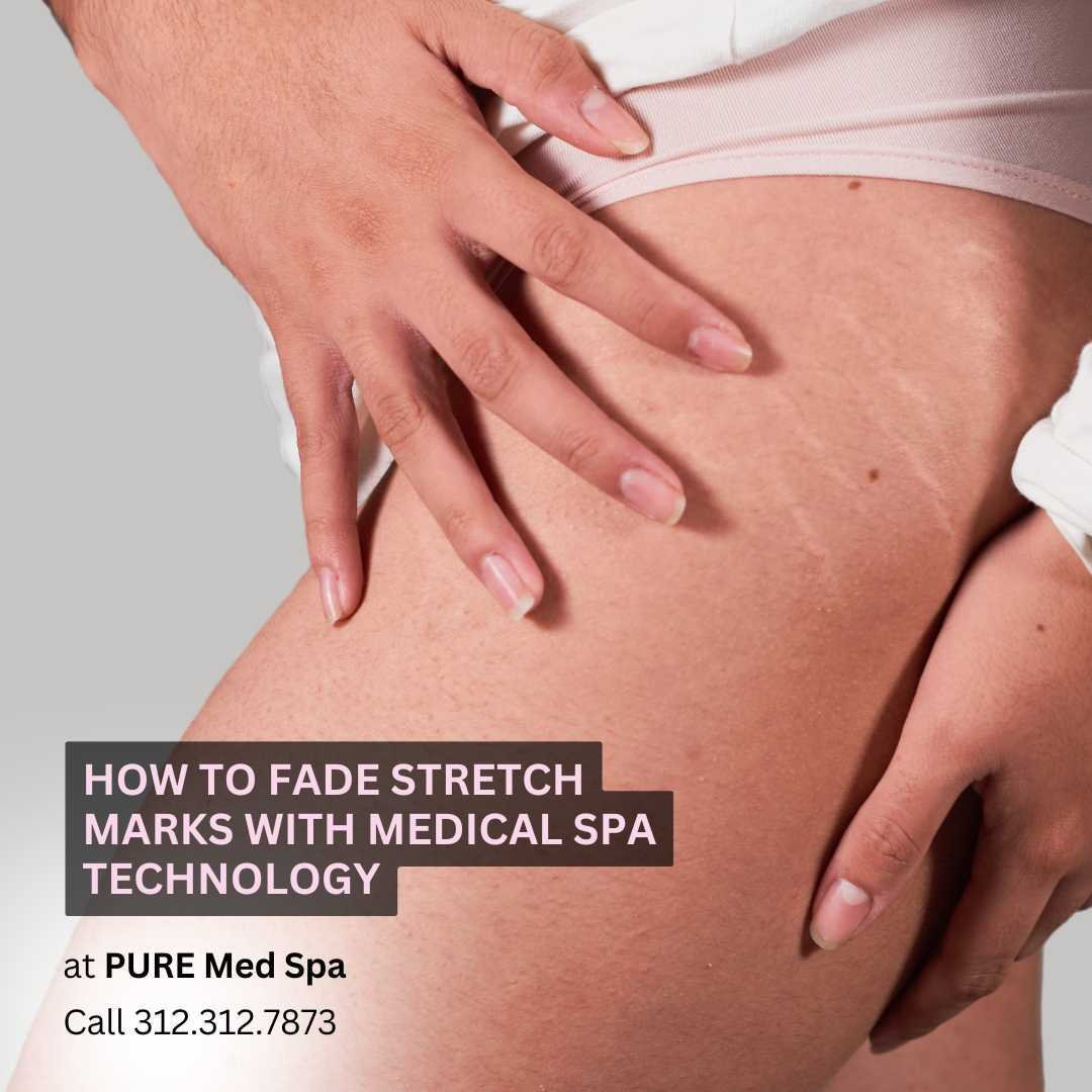 How to Fade Stretch Marks with Medical Spa Technology How to Fade Stretch Marks with Medical Spa Technology
