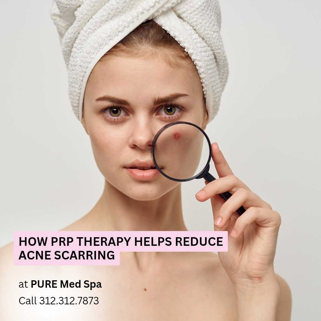 How PRP Therapy Helps Reduce Acne Scarring How PRP Therapy Helps Reduce Acne Scarring