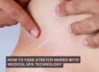 How to Fade Stretch Marks with Medical Spa Technology