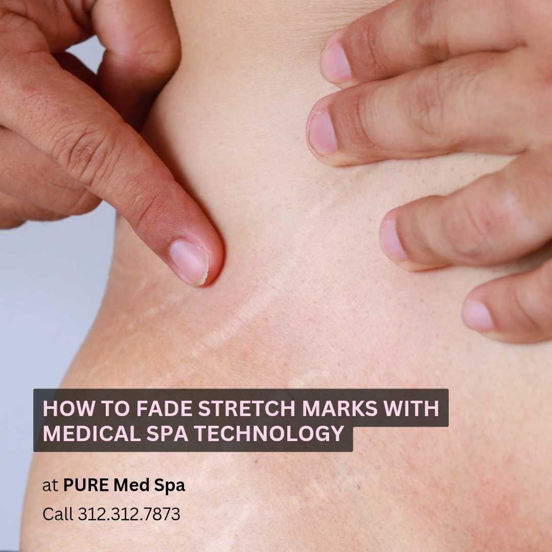 How to Fade Stretch Marks with Medical Spa Technology How to Fade Stretch Marks with Medical Spa Technology