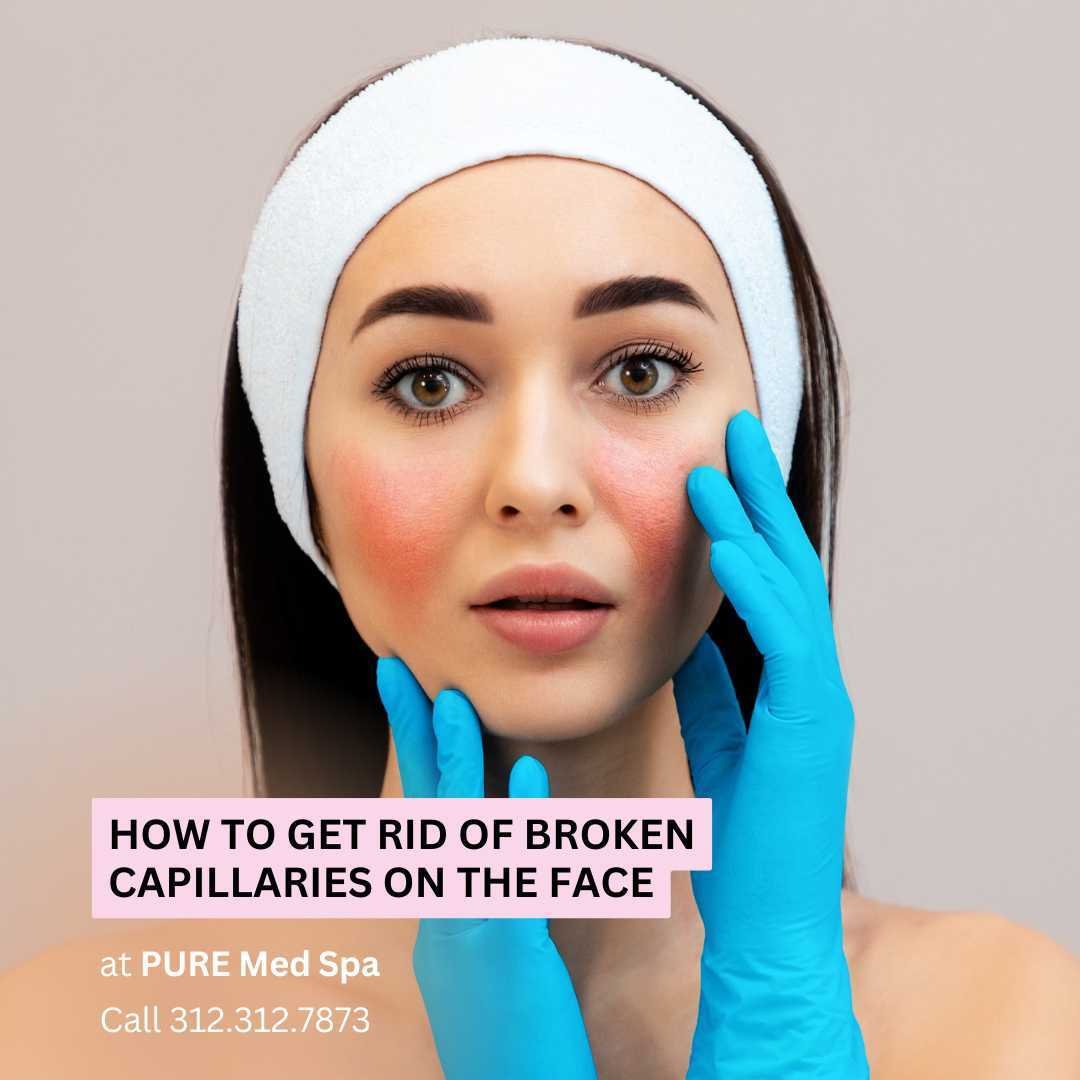 How to Get Rid of Broken Capillaries on the Face How to Get Rid of Broken Capillaries on the Face