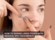 How to Shrink Large Pores