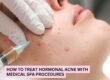 How to Treat Hormonal Acne with Medical Spa Procedures