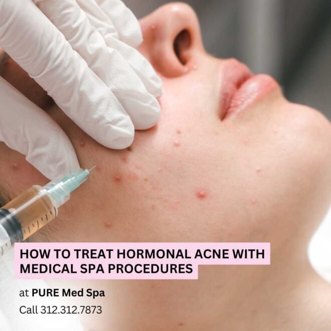 How to Treat Hormonal Acne with Medical Spa Procedures How to Treat Hormonal Acne with Medical Spa Procedures