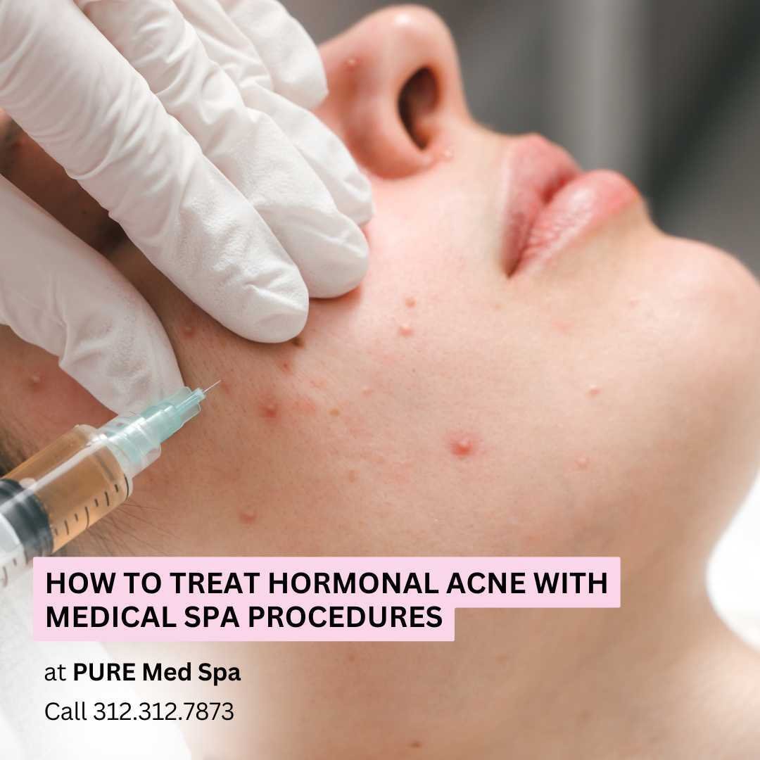 How to Treat Hormonal Acne with Medical Spa Procedures How to Treat Hormonal Acne with Medical Spa Procedures