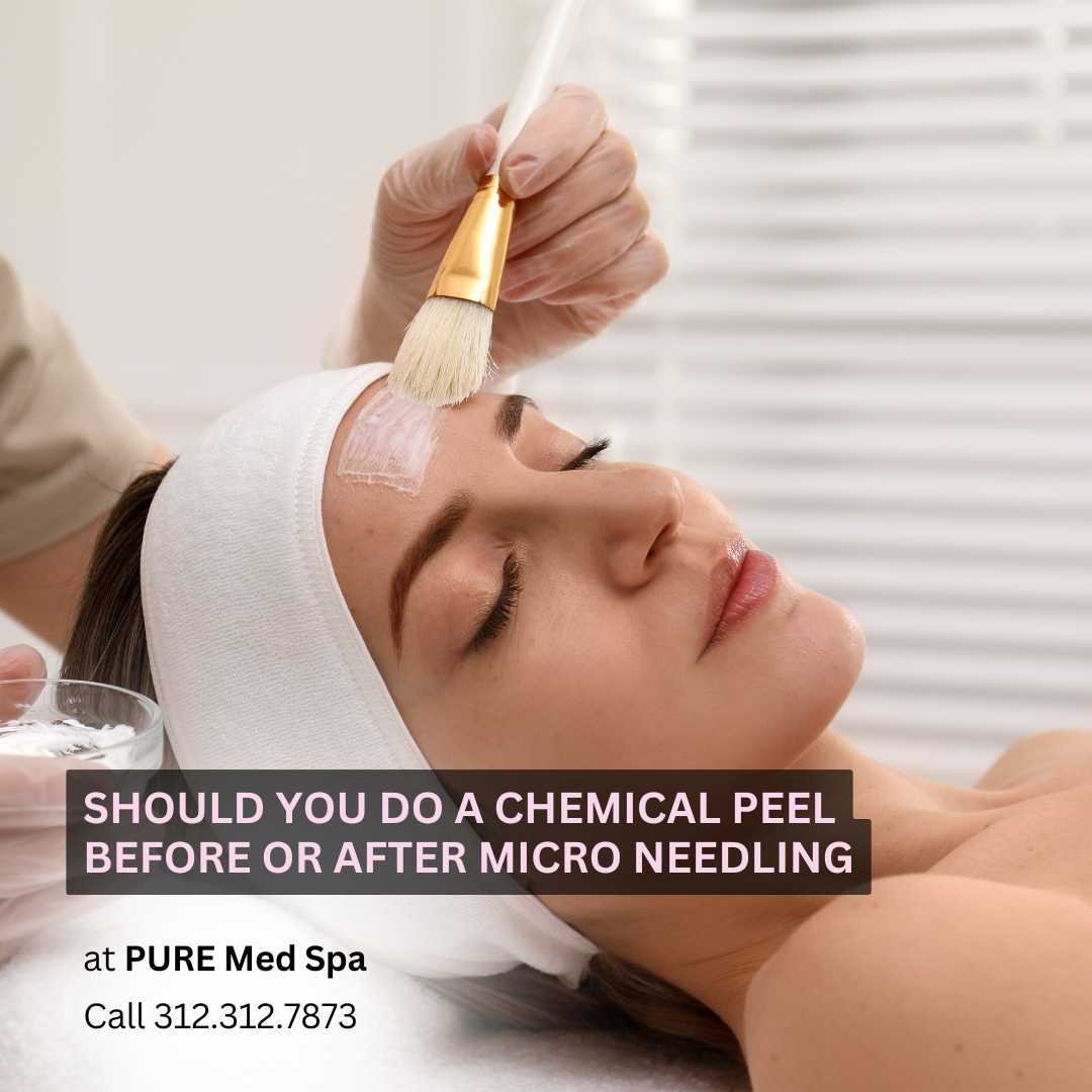 Should You Do a Chemical peels Should You Do a Chemical peels