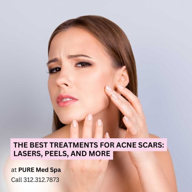 The Best Treatments for Acne Scars The Best Treatments for Acne Scars