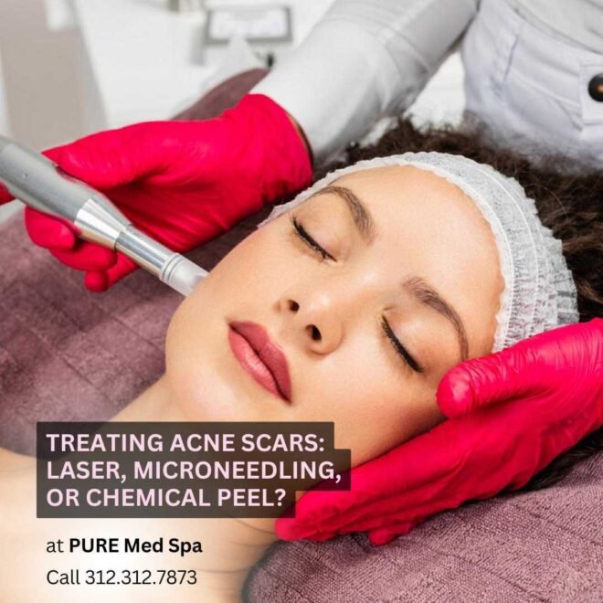 Treating Acne Scars Laser, Microneedling, or Chemical Peel Treating Acne Scars Laser, Microneedling, or Chemical Peel