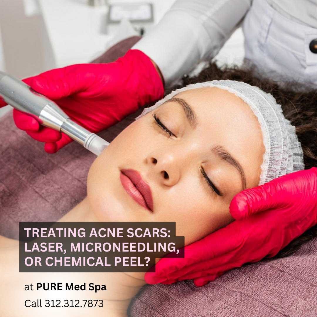 Treating Acne Scars Laser, Microneedling, or Chemical Peel Treating Acne Scars Laser, Microneedling, or Chemical Peel